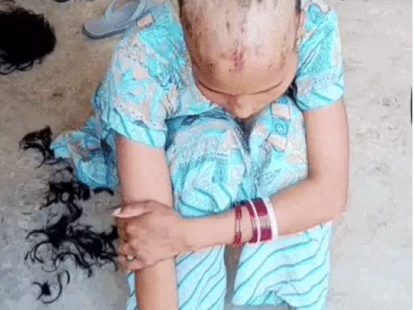 लिव-इन पार्टनर ने युवती पर किया हमला, शराब पीने से रोकने पर काटे बाल, बाजू भी तोड़ी