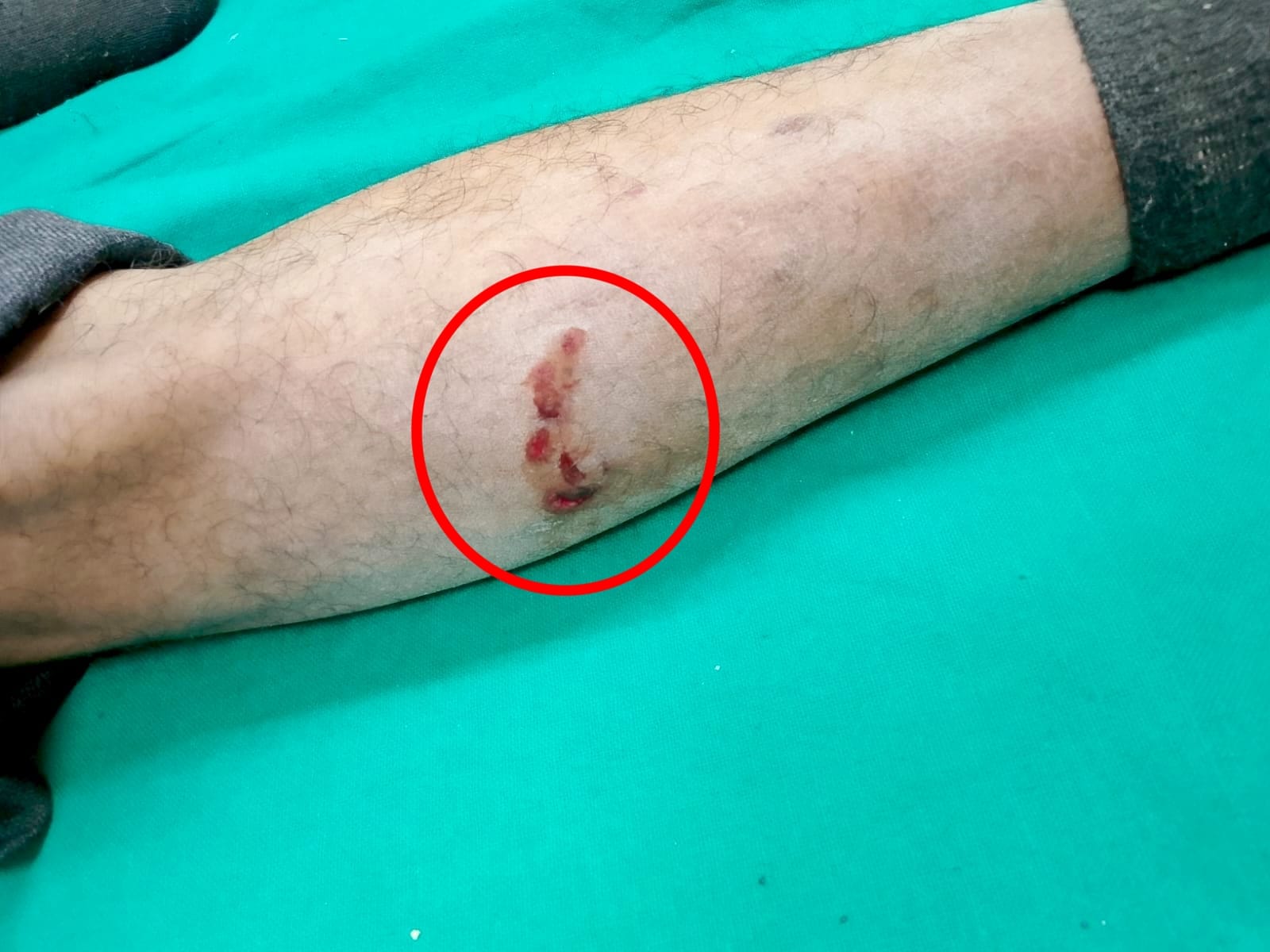 ज़ीरकपुर के ढकोली में कार मैकेनिक को आवारा कुत्ते ने काटा